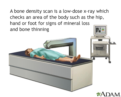 Bone density scan