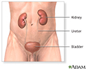 Kidney removal (nephrectomy) - series