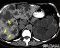 Kidney and liver cysts - CT scan