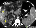 Hepatocellular cancer - CT scan