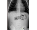 Intussusception - X-ray