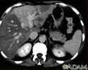 Liver with disproportional fattening - CT scan