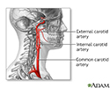 right hand presentation -                          Carotid artery surgery - series