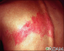 Herpes zoster (shingles) on the back