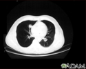 Lung nodule, right lower lung - CT scan