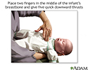 Heimlich maneuver on infant