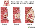 Stages of cancer