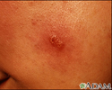 Leishmaniasis, mexicana - lesion on the cheek