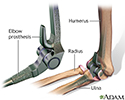 Elbow prosthesis