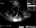 Ultrasound, normal fetus - arm and legs