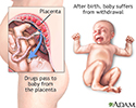Neonatal abstinence syndrome