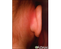 Mastoiditis - redness and swelling behind ear