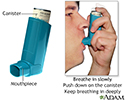 Inhaler medication administration