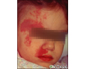 Port wine stain on a child's face