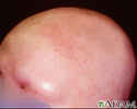 Alopecia totalis - front view of the head
