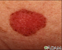Skin cancer, basal cell carcinoma - spreading