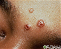 Cryptococcosis on the forehead