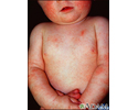 Dermatitis - atopic in an infant