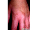Photocontact dermatitis on the hand
