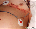 Herpes zoster (shingles) disseminated