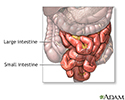 right hand presentation -                          Small bowel resection - series