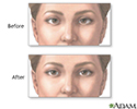 Before and after strabismus repair