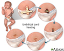 Umbilical cord healing
