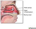 Nasal polyps