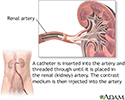 Renal arteries