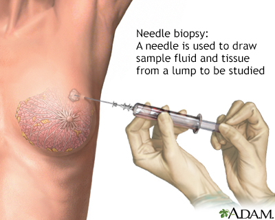 Needle biopsy of the breast