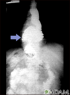 Hiatal hernia - X-ray