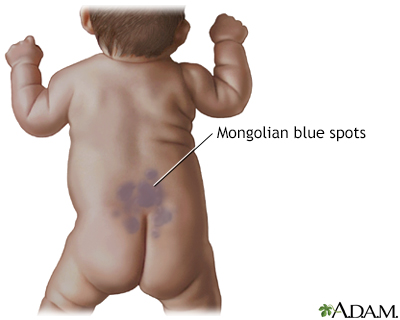 Mongolian blue spots