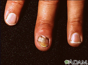 Nail infection - candidal
