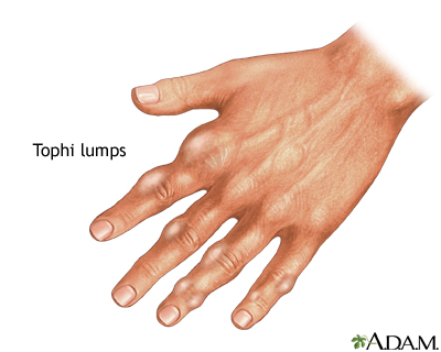 Tophi gout in hand