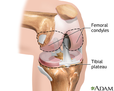 Knee joint replacement - Series