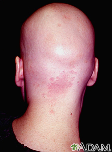 Alopecia totalis - back view of the head