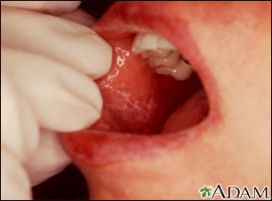 Lichen planus on the oral mucosa