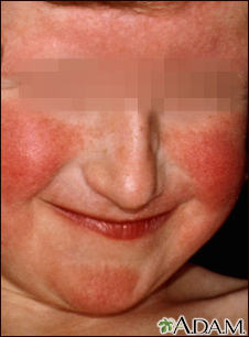 Dermatitis - atopic on a young girl's face