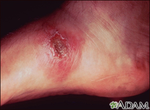 Leishmania panamensis on the foot