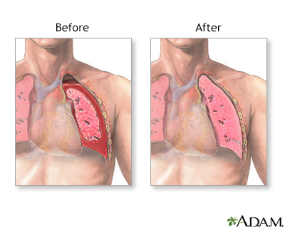 Before and after chest tube insertion