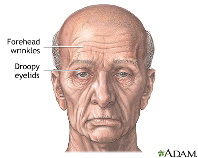 Forehead lift - series