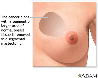 Mastectomy - Procedure part 1