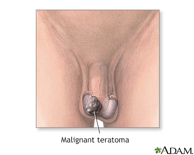 Malignant teratoma