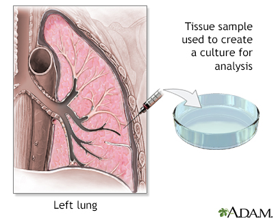 Lung tissue biopsy