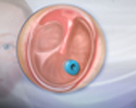 Ear tube insertion