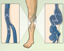 Varicose veins overview